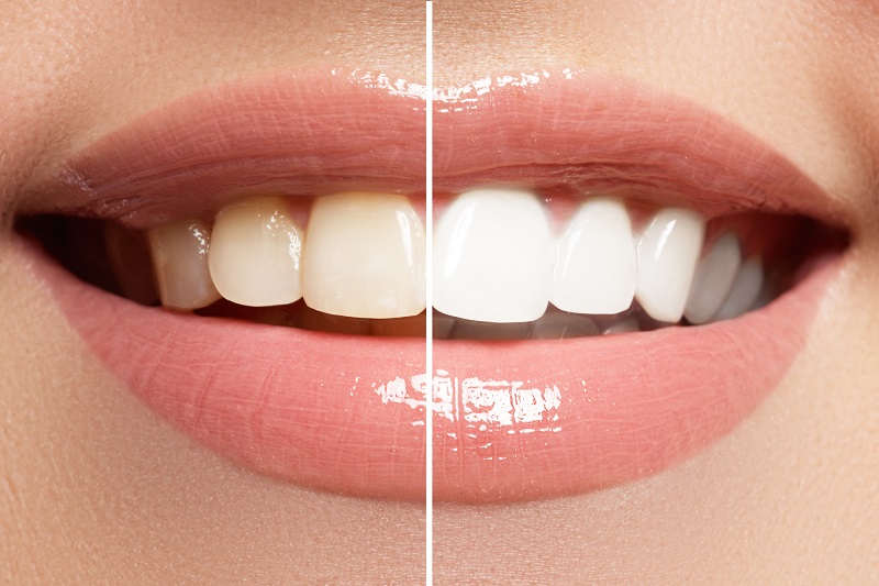Teeth Whitening Is One Example Of Cosmetic Dentistry Offered At Lee Plaza Dental