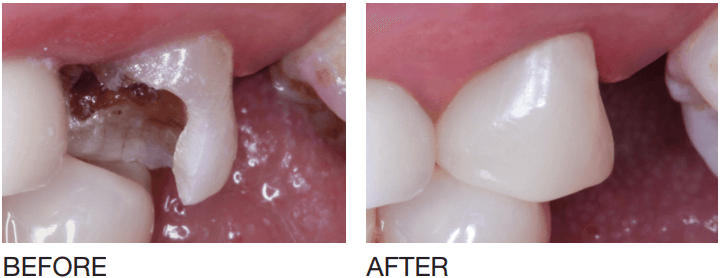 Broken Teeth Before and After