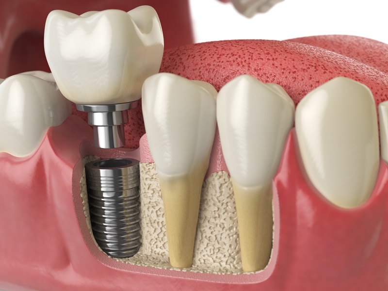 Implant Restorative Services