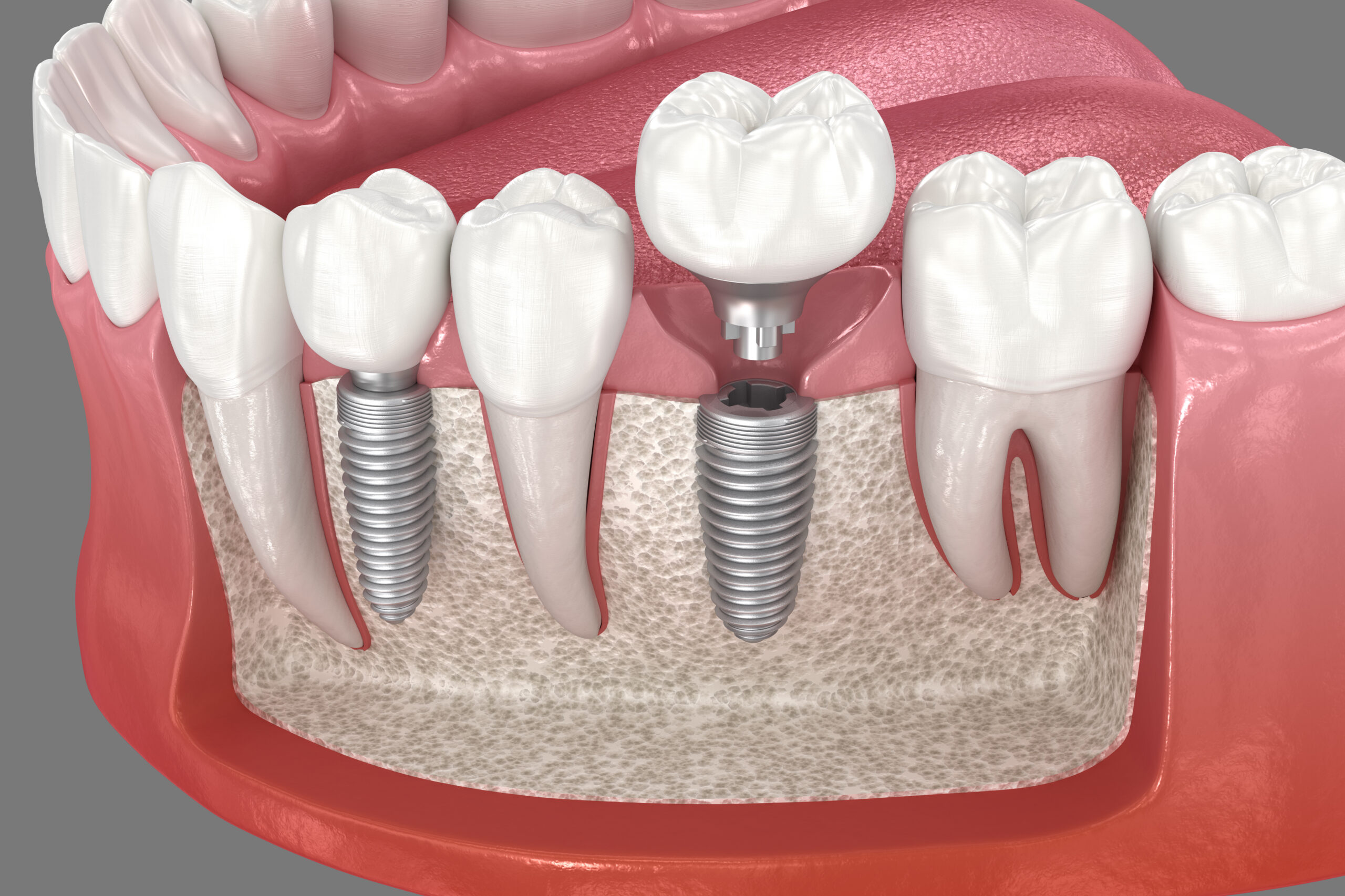 Dentist using a tooth model to explain dental implants to a patient in Kansas City.